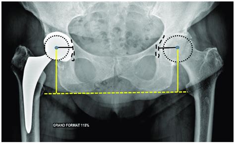 Acetabular Centers Of Rotation Pelvic Anteroposterior Radiograph The