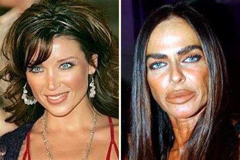 7 Worst Plastic Surgeries Fails In Hollywood Top Ten Lists Of Everything