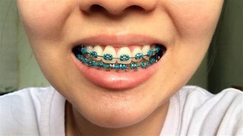 pin by 🎀🍭ari barbie🍭🎀 on bᏒᎪᏟᎬ braces colors orthodontics braces teeth braces