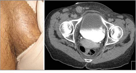 Figure 1 From Acquired Ichthyosis Revealing An Underlying Hodgkins Lymphoma Semantic Scholar