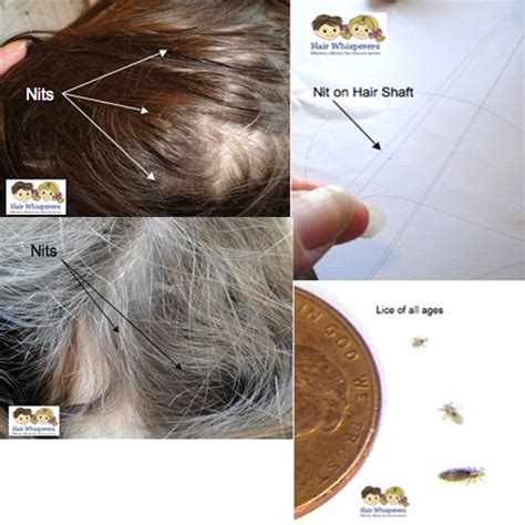 Head Lice Treatment Pictures Hair Whisperers La Sd