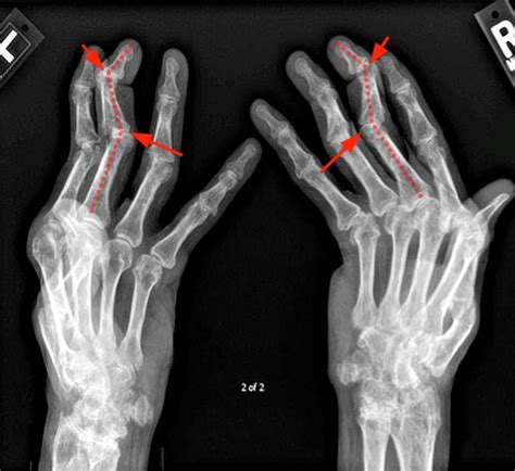 Mr Imaging Of Rheumatoid Arthritis Radsource