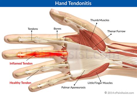 Hand Tendonitis Causes Risk Factors Symptoms Treatment
