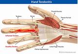 Photos of Medical Treatment For Tendonitis