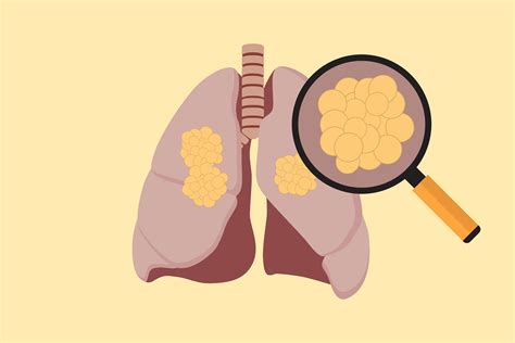Racial Disparities In Lung Cancer Start With Research Kff Health News