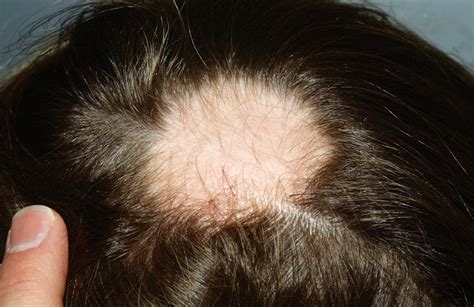 The Different Types Of Alopecia And How To Treat Them Nursa