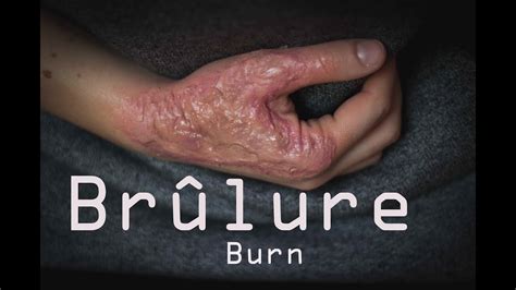 Brûlure Vive Réaliste Sfx Makeup Burn Tutorial 3rd Silicone Youtube