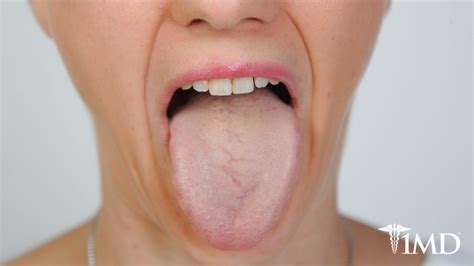 Why Your Tongue Is Yellow And Tips On How To Change It Back To Pink 1md