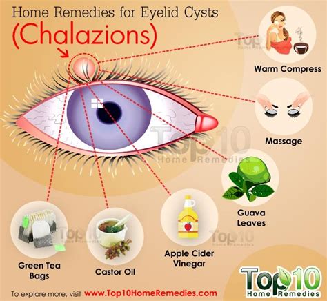 Home Remedies For Eyelid Cysts Chalazions Top 10 Home Remedies