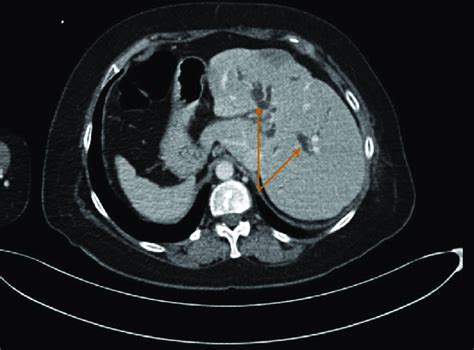 Coronal View Of The Ct Of The Abdomen Showing The Dilated Intrahepatic