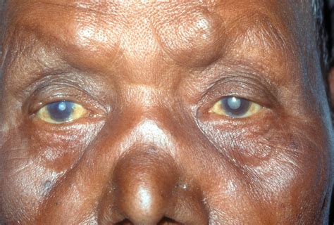 Community Eye Health Journal » Update on ocular leprosy