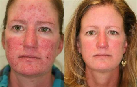 Is laser hair removal safe? Rosacea - Before and After