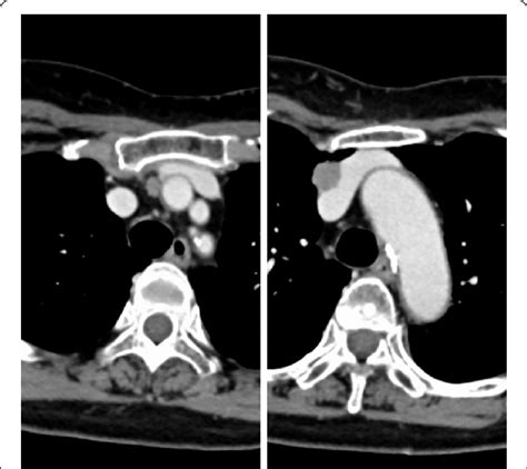 Chest Computed Tomography Ct Revealed A Recurrent Lesion In The