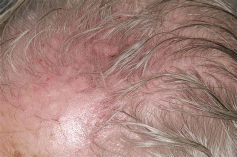 Scalp Irritation After Shingles Photograph By Dr P Marazziscience