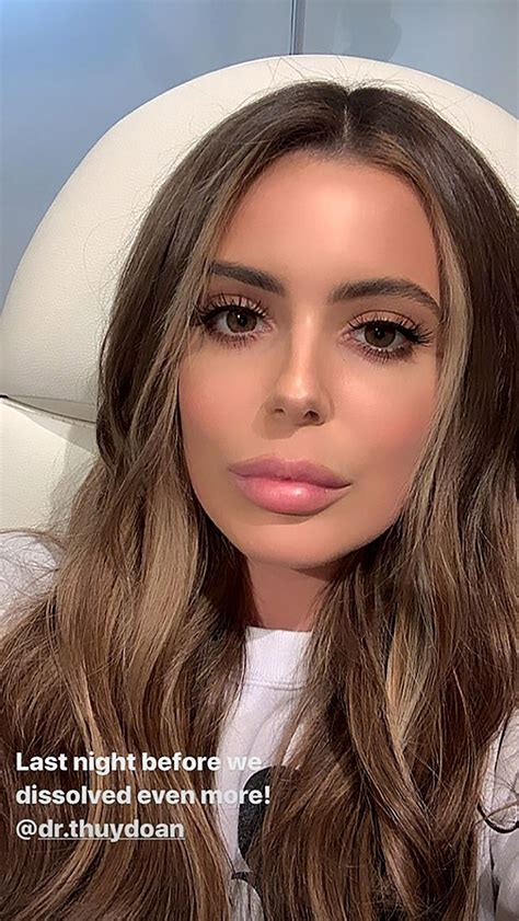 Brielle Biermann Reveals Dramatic New Look After Announcing She Dissolved Her Lip Fillers Lip