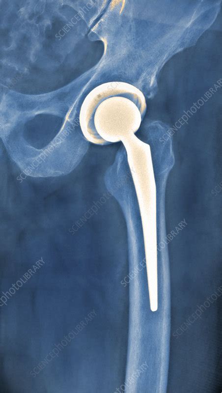 Total Hip Replacement X Ray Stock Image C0034815 Science Photo Library