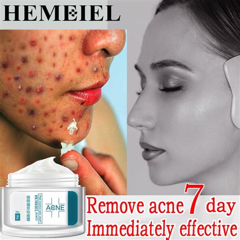 HEMEIEL Pimples Acne Remover Best Seller Mabisang Gamot Sa Tigyawat