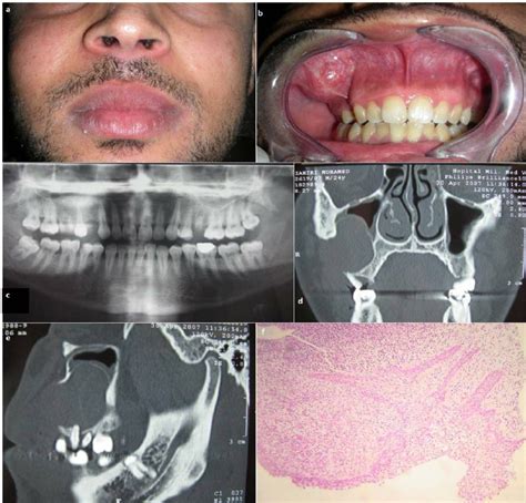 The Clinical Photograph Showing Swelling Extraorally On The Right Cheek