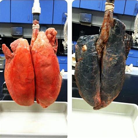 Comparing Smokers Lungs To Non Smokers Lungs Medizzy