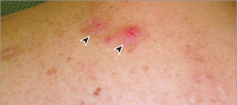 Diffuse Cutaneous Pseudolymphoma Due To Therapy With Medicinal Leeches