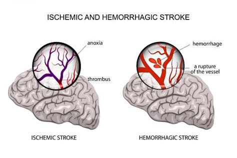 What Are The Different Types Of Strokes