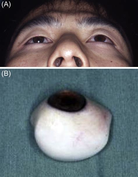 Secondary Reconstruction Of A Mobile Eye Socket 30 Years After