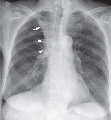 Tumors Of The Lung Radiology Key