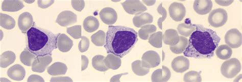 Large Granular Lymphocytes Detected On Peripheral Blood Smear The