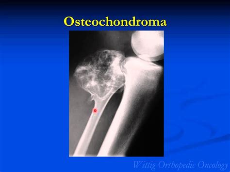 Orthopedic Oncology Course Radiology Of Musculoskeletal Tumors