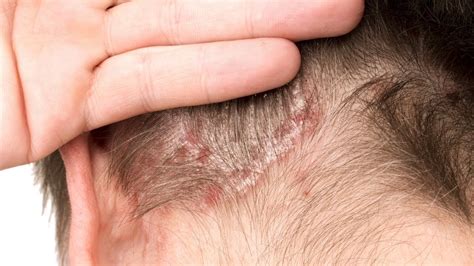 What Is Plaque Scalp Psoriasis Pictures Symptoms Photos Images