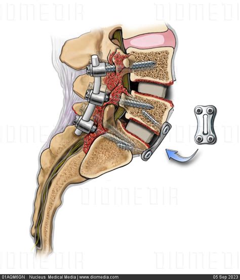 Stock Image Illustration Of An L5 S1 Bone Fusion Of The Lumbar Spine