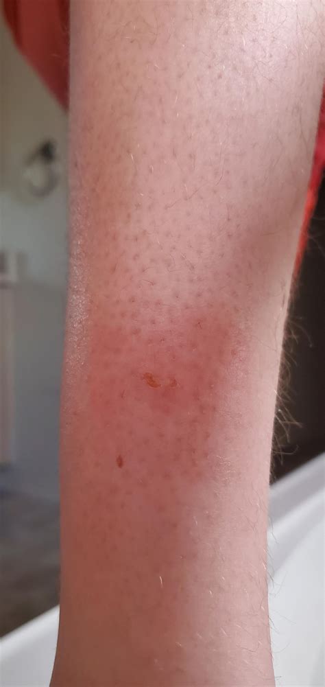 noticed-this-bug-bite-yesterday,-its-sorta-swollen,-and-has-yellow-crap-its-hard-coming-out-of