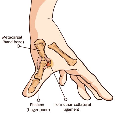 Choose from 364 different sets of flashcards about medial collateral ligament on quizlet. Tore a ligament in my hand/thumb | TigerDroppings.com
