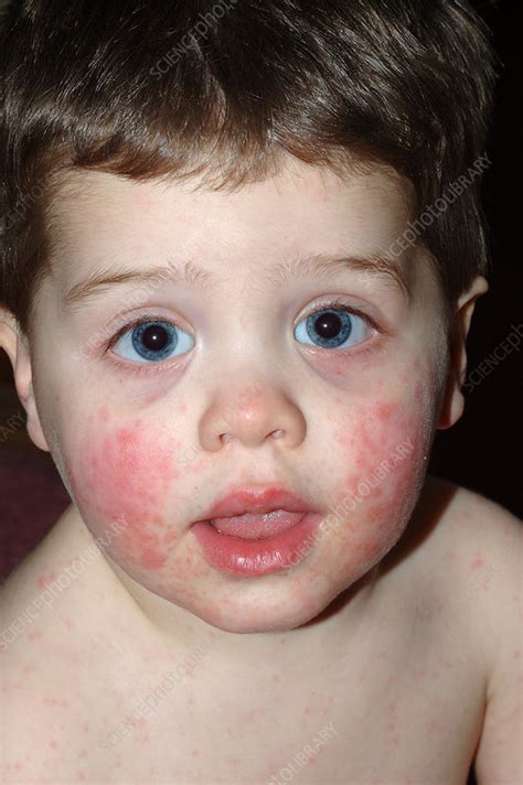 Fifth Disease Stock Image C0220892 Science Photo Library