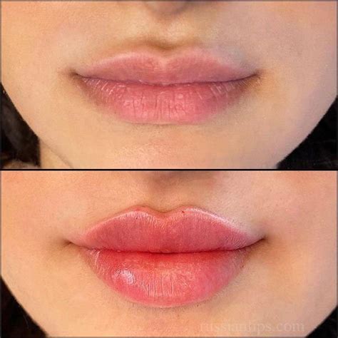 Russian Lip Filler Technique Vs Normal What S The Difference The