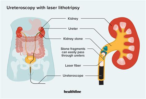 Ureteroscopia Com Litotripsia A Laser Tratamento Para Cálculos Renais