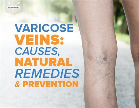Varicose Veins Causes Natural Remedies And Prevention