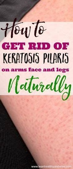 How To Get Rid Of Keratosis Pilaris On Arms Face And Legs Naturally