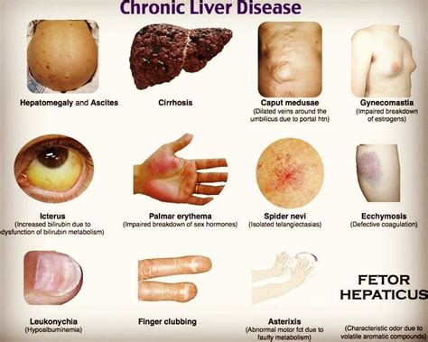 Liver Cirrhosis Early Stage Ascites Symptoms Symptoms Of Disease