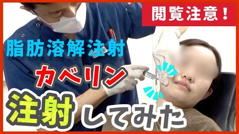 脂肪溶解注射（頬と顎下）のカベリン注入施術動画を公開します！【プチ整形】 Youtube