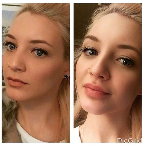 botox lip injections before and after my xxx hot girl