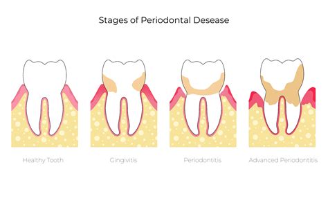 Gingivitis Vs Periodontitis Whats The Difference Sarasota Dentistry