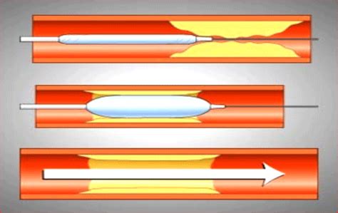 Percutaneous Transluminal Coronary Angioplasty (PTCA ...