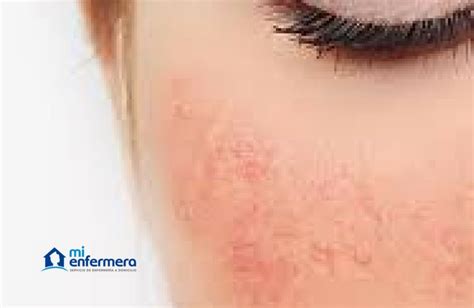 Dermatitis De Contacto 6 Síntomas Para Detectarla Y Cómo Cuidarte De