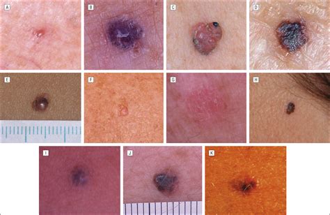 Historical Clinical And Dermoscopic Characteristics Of Thin Nodular