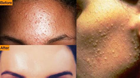 Get Rid Of Tiny Bumps On Face Simple Home Remedy Mamtha Nair Youtube