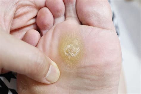 What To Do And Not To About Your Corns Or Calluses Trinity Foot Center
