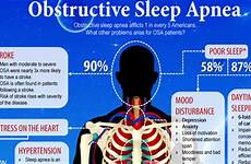 sleep apnea osa obstructive ent