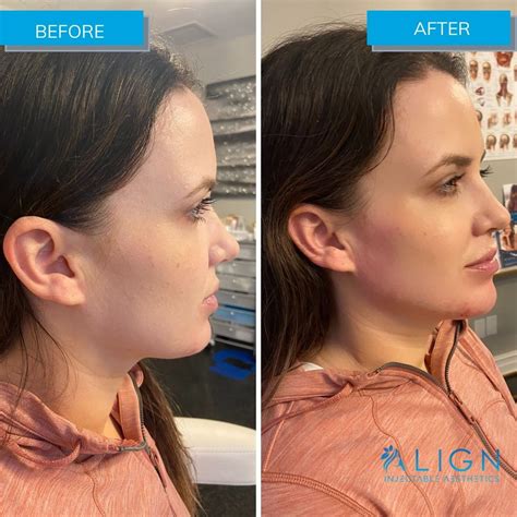 Before And After Jawline Filler Align Injectable Aesthetics