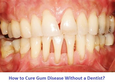 How To Cure Gum Disease Without A Dentist Look Here